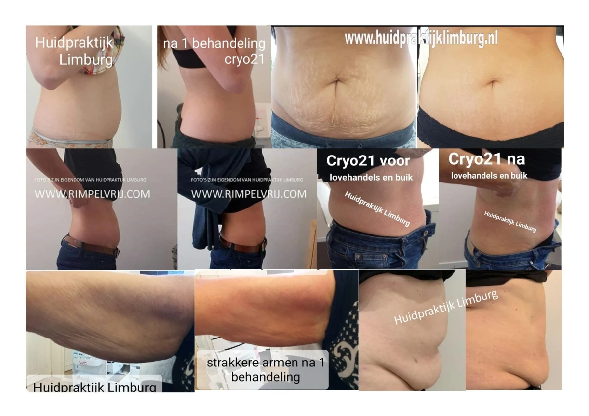 cryo21