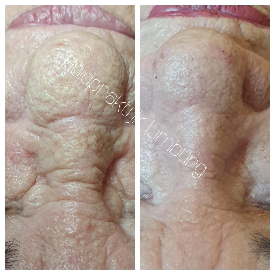 verjonging en porien behandeling, neus lift