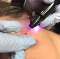 Plasma Specialist voor huidverjonging, huidverstrakking en huidverbetering zonder botox of fillers