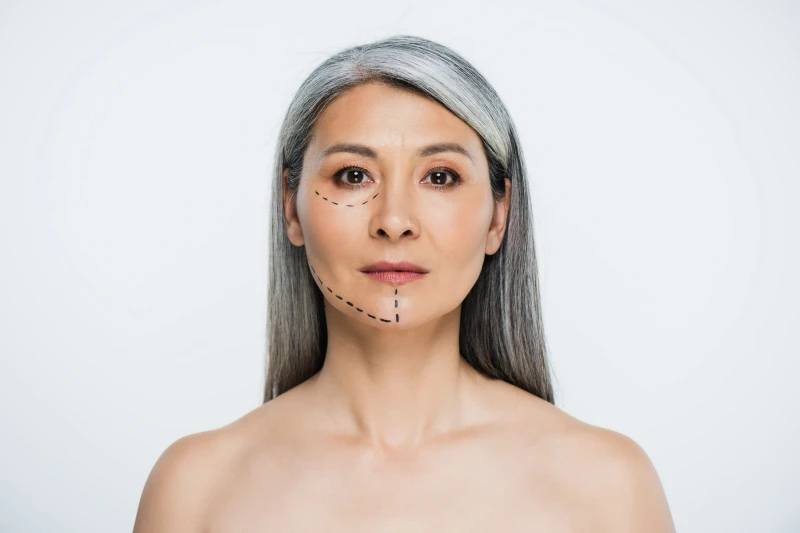 Face lift zonder operatie